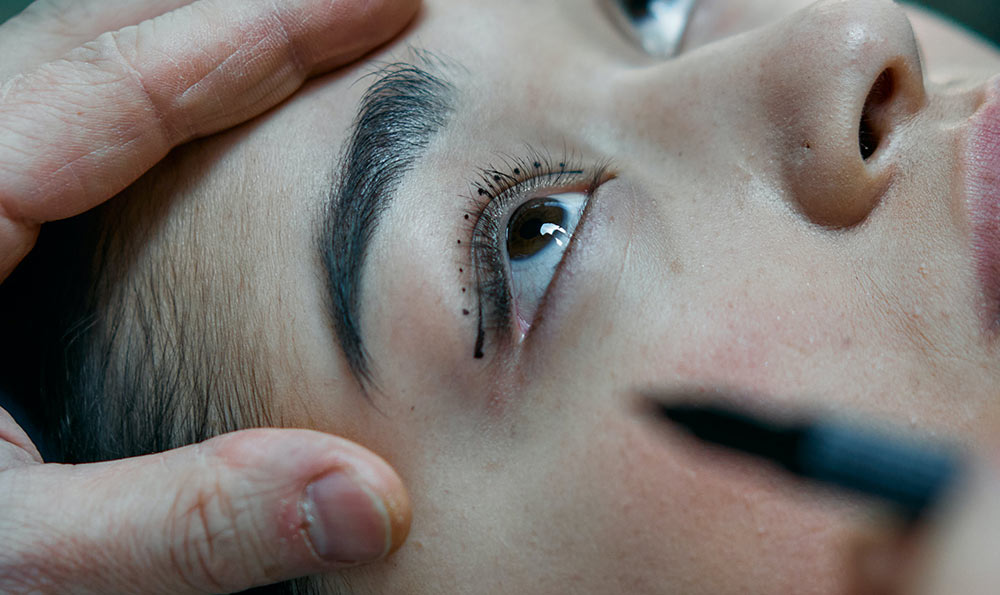 下眼瞼提升術(shù)疤痕